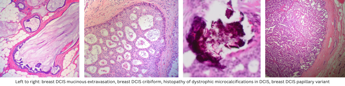Different Forms of DCIS